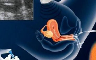 杭州试管婴儿医院排名一览，附试管成功率费用明细